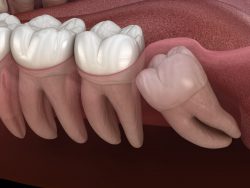 What you should know about wisdom teeth removal?