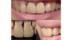 Procedure for Dental Crowns