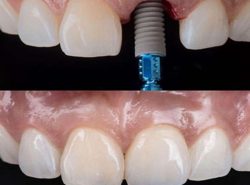 Affordable Dental Implant Near Me