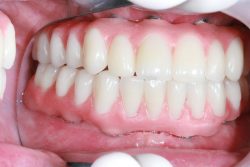 Affordable Partial Dentures Near Me