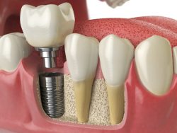 Dental Implants Specialist