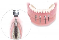 Dental Implants in Sunny Isles Beach