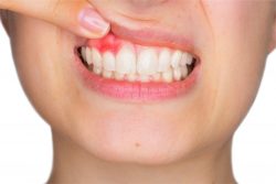 Gum Disease Treatment Near Me