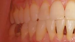 Gingivitis Treatment Near Me