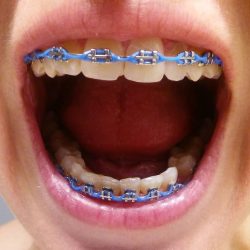 Braces power chain colors