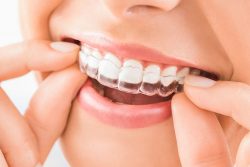 How Much Do Clear Braces Cost?