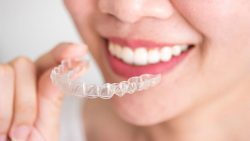 How Much Do Clear Braces Cost?