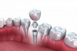 What Are Dental Implants?