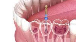 What Is A Root Canal Treatment?