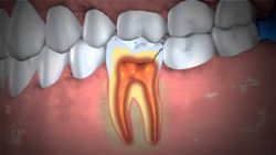 Treatment for Abscess Tooth Infection | Symptoms of An Infected Tooth