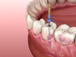 Treatment for Abscess Tooth Infection | Symptoms of An Infected Tooth