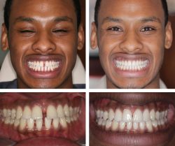 invisalign before and after pictures