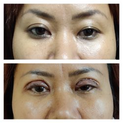 Eye Lift Surgery Cost – Premiere Surgical Arts.