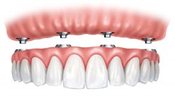 Affordable Dentures Near Me | Full & Partial Dentures Houston Tx