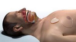 How Much Does Sleep Apnea Treatment Cost?