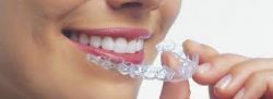 Invisalign Treatment Near Me in Miami – orthodontistbrace