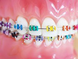 Choose Best Colors For Your Braces