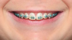 Best Braces Colors Ideas