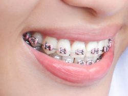 Choose the Best Braces Colors