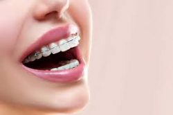 Advantages Of Adult Orthodontics Near Me