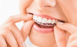 Invisalign Treatment Process | Invisalign Treatment Time Process