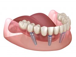 Best Dentist for Dental Implants near me