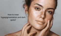 hyperpigmentation