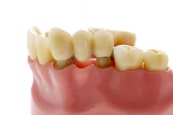 Types of Dental Bridges