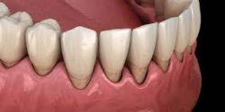 Periodontal Disease Treatment