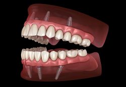 Porcelain Crown and Bridges | Single Front Tooth Crown Before And After