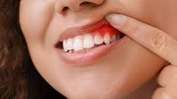 What Causes Gum Disease?