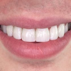 The Benefits Of Getting A Dental Filling