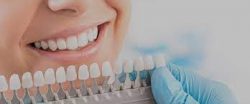 Dental Veneers Houston TX | Porcelain Veneers Cost Near Me