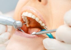 Dental Bridges Miami Beach, FL | Miami Beach Smiles