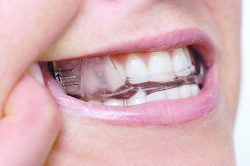 Oral Appliance Therapy for Sleep Apnea