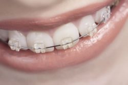 Invisalign in and near Miami, FL