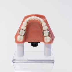 Braces Cost in Miami,FL | Braces in and near Miami, FL