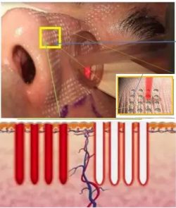 Fractional laser