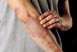 3 Proven ways to get rid of contracture scars