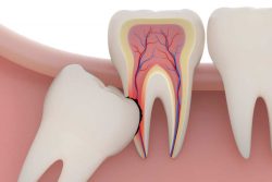 Wisdom Teeth Removal in Miami, FL