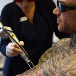 Best Laser Tattoo Removal NY | Skin Clinic Tattoo Removal NY – Bared Monkey