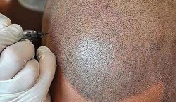 Hair Transplant