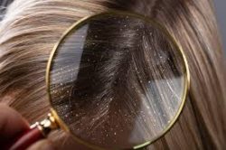 Dandruff Treatment in Bangalore