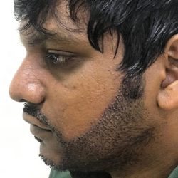 Beard Transplant