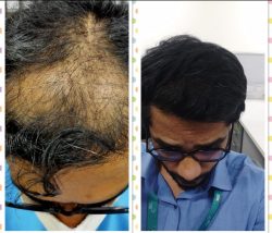 Partial / Complete Balding or Alopecia