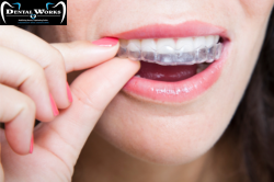 Best Invisible braces treatment in Delhi