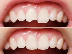 Dental Crown Repair Near Me