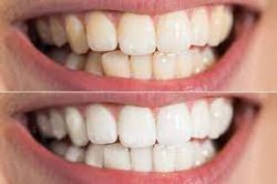 Professional Teeth Whitening Near Me | Teeth Whitening