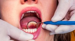 Deep Teeth Cleaning Near Me | Teeth Cleaning Before And After