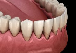 Gum Graft | Houston TX | J. Robert Friedberg DMD